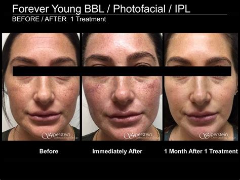 Two or three treatments may be needed, depending on the extent of damage and one’s goal for their skin. . Bbl laser vs fraxel